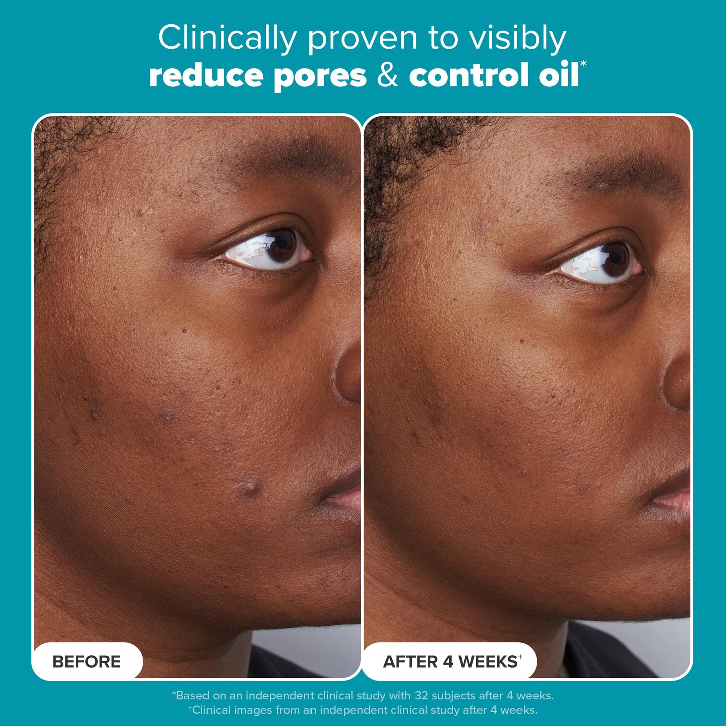 Paula's Choice Skin Perfecting 2% BHA Liquid Salicylic Acid Exfoliant, Gentle Facial Exfoliator for Blackheads, Large Pores, Wrinkles & Fine Lines, Travel Size, 1 Fluid Ounce